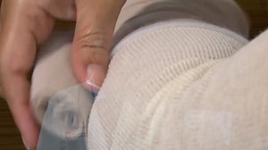 Learn about lymphedema—painful swelling that affects some cancer patients—and how innovative treatments are helping patients at @osu. | OSUCCC-James Cancer Hospital and Solove Research Institute