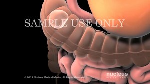 6.4K views · 51 reactions | COLECTOMÍA (TRATAMIENTO QUIRURGICO PARA...