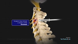 Posterior Cervical Foraminotomy