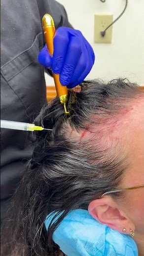 PRP Injections with Micro-Needling to Promote Hair Growth