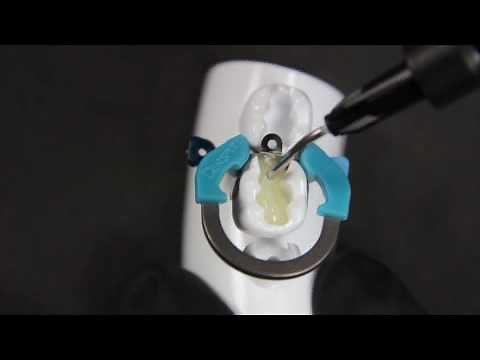 Easy obtention of a tight contact point using Palodent V3 + SDR. By Dr. Andre Reis