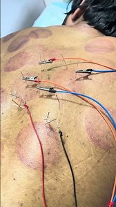 Dry Needling for Trigger Point Pain Relief 😱