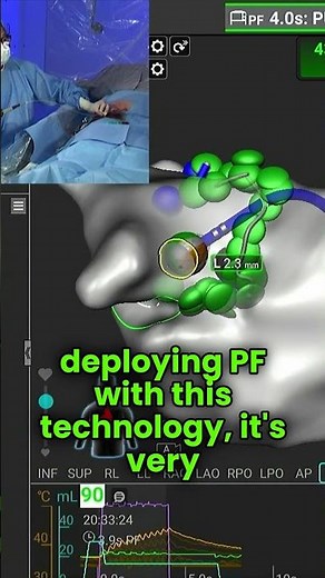 Affera Mapping and Ablation System with Sphere-9 Catheter