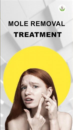 Mole Gone in Seconds! 😲 Real Laser Removal Treatment in Delhi | Care Well Medical Centre