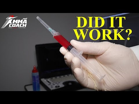 Stem cell therapy for knees - has it worked for me?