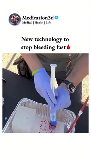 Medical | Health | Life on Instagram: "This device represents a new approach to rapid bleeding control. 🩸Using a syringe-like applicator, small compressed sponge pellets are delivered into a wound, where they quickly expand upon contact with blood or fluid. The expansion creates internal pressure that helps stop bleeding fast-especially in deep or irregular wounds where traditional compression is difficult. Use cases include: 1️⃣Emergency trauma care 2️⃣Severe bleeding in accidents or disasters