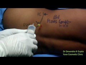 Devendra's Technique of Bilateral Psoas Compartment block