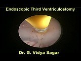 Endoscopic 3Rd Ventriculostomy • Video • MEDtube.net