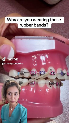 Rubber Bands for Braces: A Comprehensive Guide