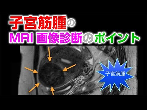 子宮筋腫のMRI画像診断のポイント