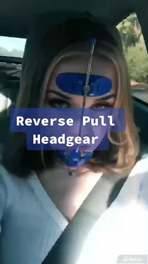 Correcting Underbites with Headgear: A Comprehensive Guide