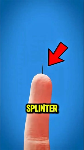 Don’t Pull a Splinter Out Too Fast… This Happens 😳