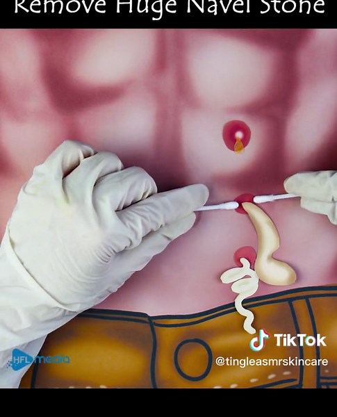 ASMR | Remove Huge Navel Stone Animation part2 #asmr #animation #navelstone #asmranimation #removal