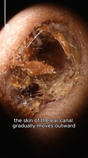 Why Cotton Swabs Don’t Belong in Your Ears