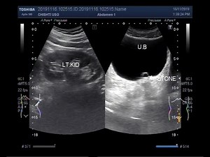 Ultrasound Video showing intravesical ureterocele also called simple ureterocele.