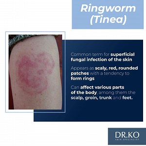 SKIN FACTS OF THE DAY Do you know we have various types of fungal infection? These are 4 example of fungal infection you need to know. Ringworm (Tinea) - It is a common term for superficial fungal infection of the skin White Spot - This condition can be aggravated by excessive sweating Fungal Acne - This is an inflammatory skin disorder triggered by yeast infection Athlete’s foot - This fungal infection usually begins between the toes which occurs in people whose feet have become very sweaty. Ko