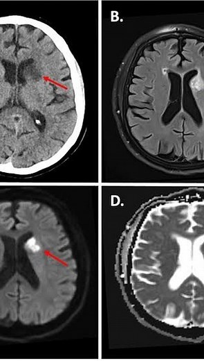 What is difference between Chorea and hemiballismus ??? #medicine #mbbs #neetss #neetpg #medicalstudent #health #healthylifestyle #tremor #physio #physiotherapy_world # | DrVishal Gabale