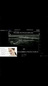 후두신경통의 치료 신경차단술과 인대강화주사 #shorts #통증의학과 #anatomy #뼈