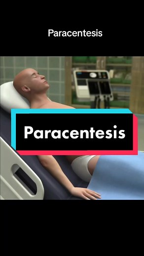 Técnica: Paracentesis Áreas recomendadas para la paracentesis. Usualmente se punciona la unión entre los dos tercios mediales con el tercio lateral, de una línea imaginaria trazada entre la espina iliaca anterosuperior y el ombligo en ambos lados. La elección del lado es de preferencia y de la experiencia del médico que va a realizar el procedimiento. #paracentesis #cirrosis #gastroenterologia #foryou