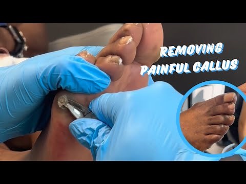 CORN (IPK) REMOVAL | THEY LOOK LIKE ROCKS! 😱