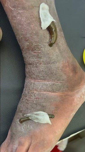 LEECH THERAPY 😳