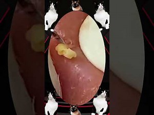 Skincare | Blackheads Removal #tweezers skincare #blackheads blackheads