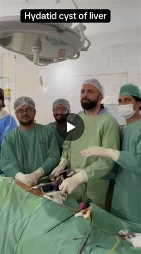 Laparoscopic Liver Surgery for Hydatid Cyst in Segments VII & VIII | Hameed Ullah posted on the topic | LinkedIn