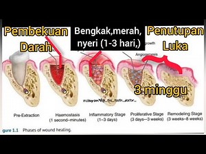 How long does it take to heal a tooth extraction, wisdom tooth surgery, or odontectomy?