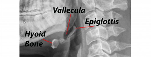The MAC Blade, The Vallecula, and the Hyoepiglottic Ligament