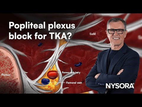 Should you add a popliteal plexus block for TKA?