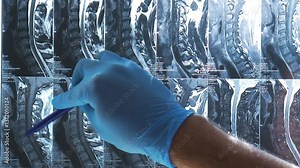 A doctor shows a problem in a patient's cervical spine on a slow-motion MRI scan. The scan reveals disc protrusions and herniations in the cervical vertebrae