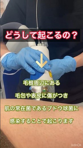 どうして脱毛すると毛嚢炎がでることがあるの？