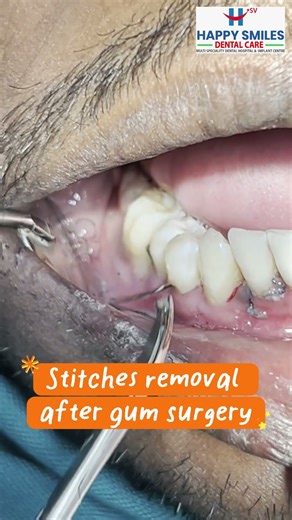 Stitches Removal After Gum Surgery || Painless Dental Treatmet@HappySmiles