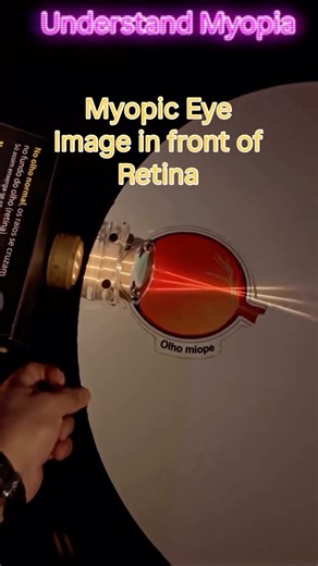 Mineesh Gulati on Instagram: "�� “Why the world looks blurry? Let’s clear it up with a ray of light!” �� #MyopiaExplained #ScienceReel #EyeCare #PhysicsInLife #VisionMatters ⸻ � Reel Description Ever wondered why distant things look blurry to some people? � Here’s a fun activity to visualize how light rays focus in a normal eye �, a myopic (short-sighted) eye �, and how corrective lenses help! Watch how: � Light rays in a normal eye focus perfectly on the retina � In myopia, they meet before the