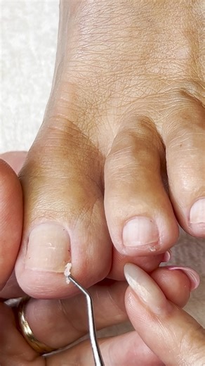 “Toenail Repair & Fungus Removal | Restoring Brittle, Painful Nails Step-by-Step” Link to vid https://www.youtube.com/watch?v=1fmyQ5V96cA 📄 In this relaxing and educational pedicure session, we help this client restore her damaged and brittle toenails caused by trauma, aging, and underlying white superficial onychomycosis. You'll see real-time restoration techniques, hear personal stories, and learn essential tips to manage common toenail issues. this video is Perfect for those dealing with: Cu