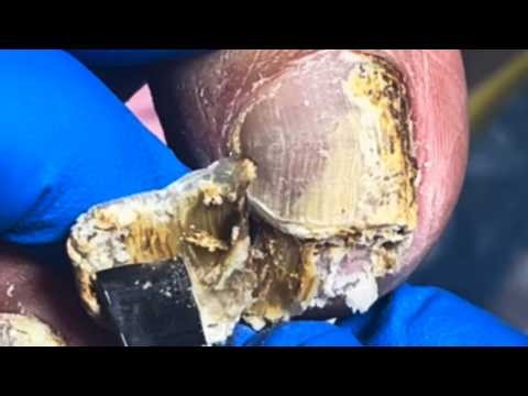 Extremely Long Onychomycosis Nails Resemble Dead Wood; Gentle Treatment Is Needed