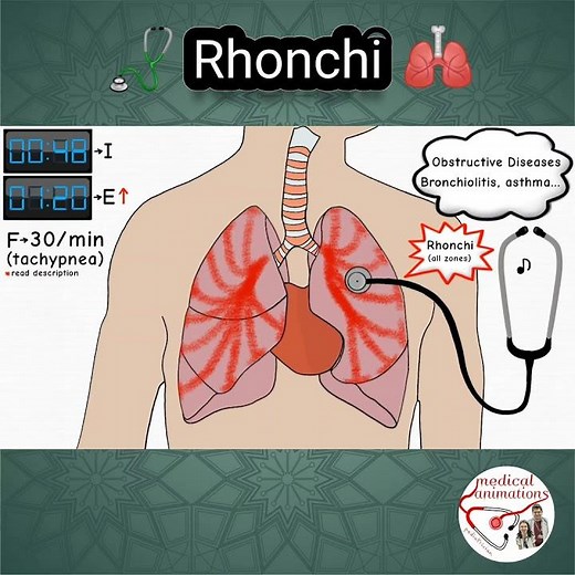 🩺 RHONCHI