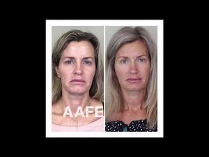 Submental Chin Tightening and Fat Removal with VSoft Lift Smooth PDO Threads