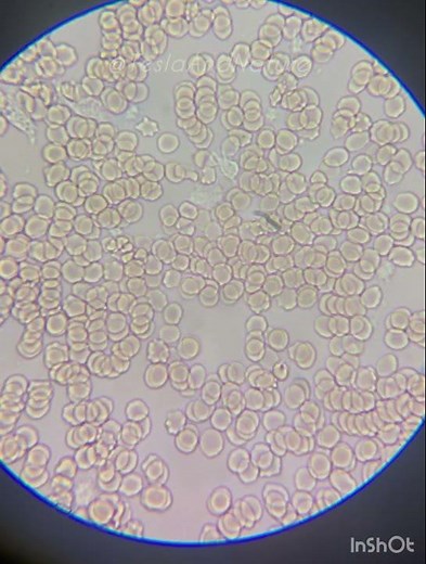 White blood cells under microscope (neutrophils)