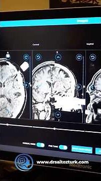 All stages of Deep Brain Stimulation (DBS) Surgery for the treatment of Parkinson’s Disease
