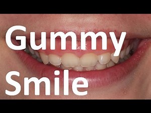 Orthotropics Treatment of Gummy Smile (Excessive Gingival Display) by Prof John Mew