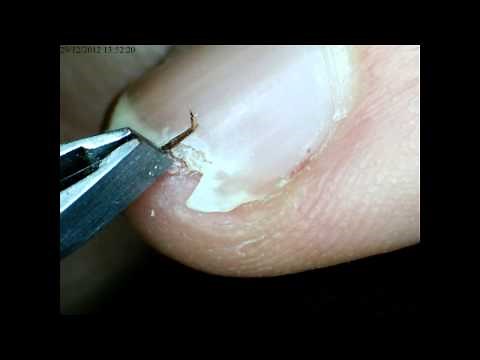 How to extract splinter from under fingernail