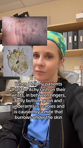 121K views · 165 reactions | Scabies is a common parasite that loves the folds of the skin. It digs under the skin creating a “burrow”- a short track on the skin shown with the arrow. Treatment is topical permethrin or or | Dr. Abby Dermatologist | Facebook