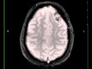 Meningioma, left frontal