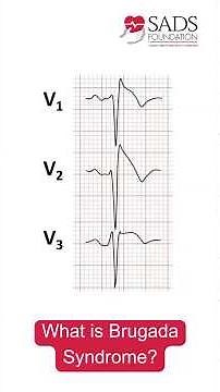What is Brugada Syndrome?