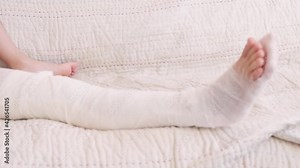 broken leg. Close-up of the cast on the feet. exercises to repair and strengthen muscles. damage to the bones. medical care of a surgeon in the emergency room