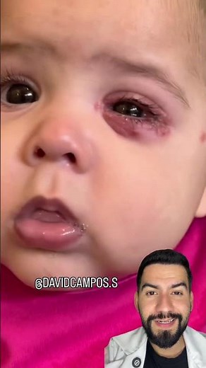 HERPES EN LOS OJOS