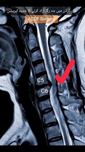 Understanding ACDF Surgery for Neck Pain Relief