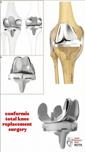 conformis total knee replacement surgery #medical #3d #animation #short | learn Biology with Aliya