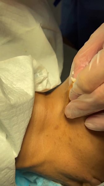 Huge cyst on the chin #acne #pimple #blackhead #clean #extractions #satisfying #foryou